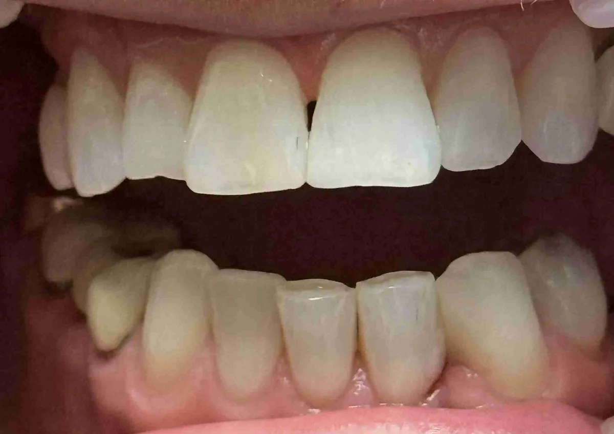 After: Gap Closure & Chipped Front Teeth Repair