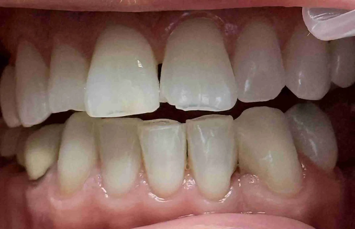 Before: Gap Closure & Chipped Front Teeth Repair