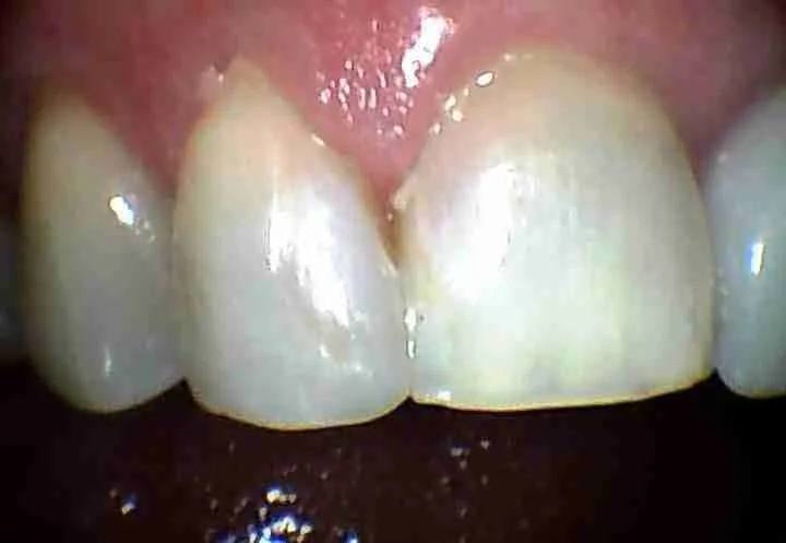After: Same-Day Composite Filling