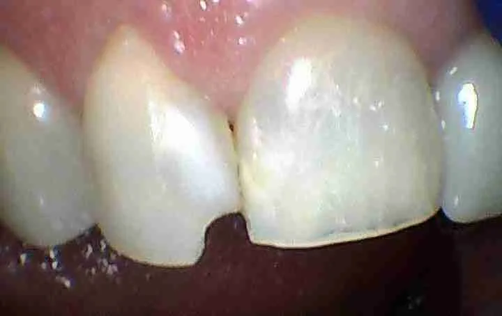 Before: Same-Day Composite Filling