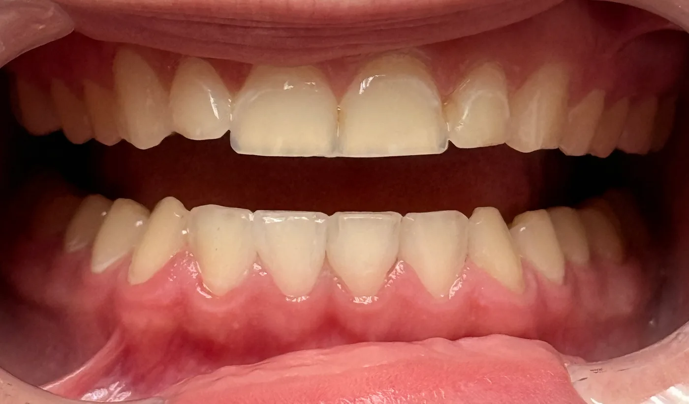 After: Closing Gaps in the Lower Front Teeth