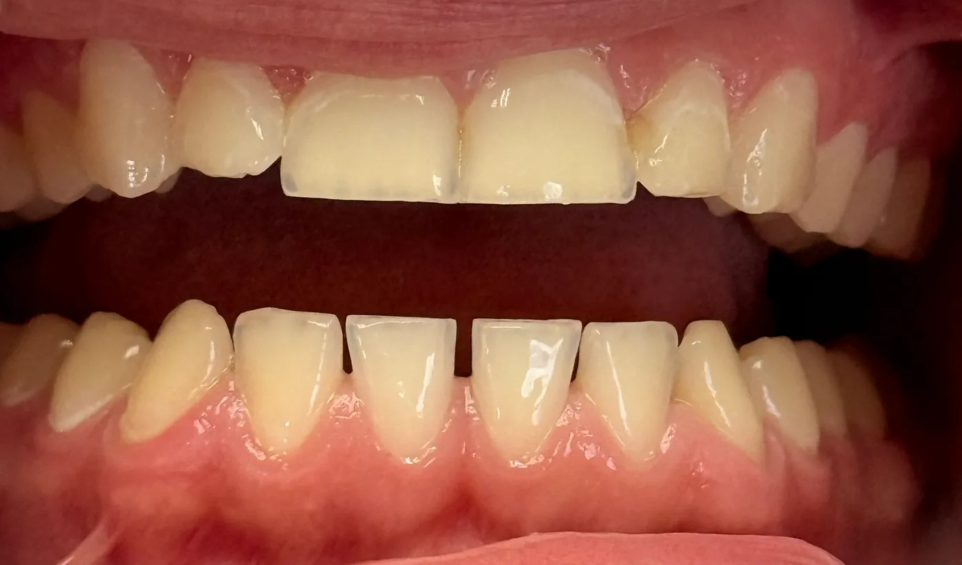 Before: Closing Gaps in the Lower Front Teeth