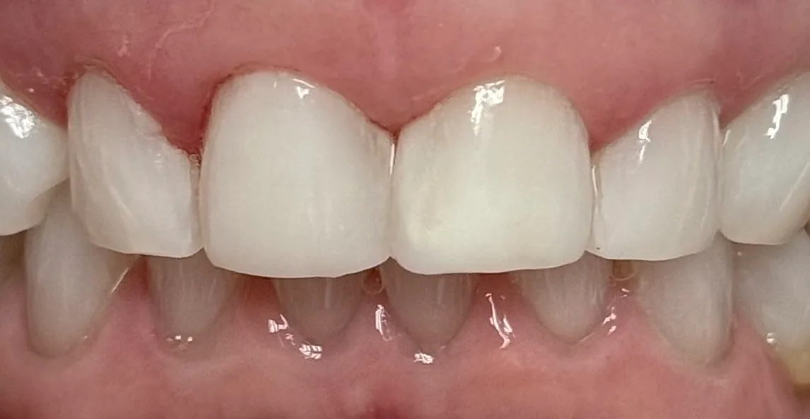 After: Chairside Composite Veneers - Closed View