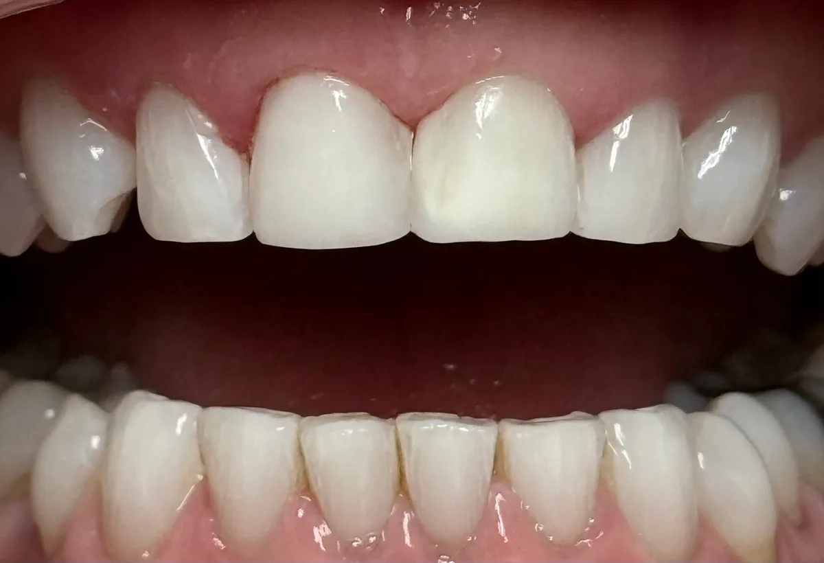After: Chairside Composite Veneers - Open View