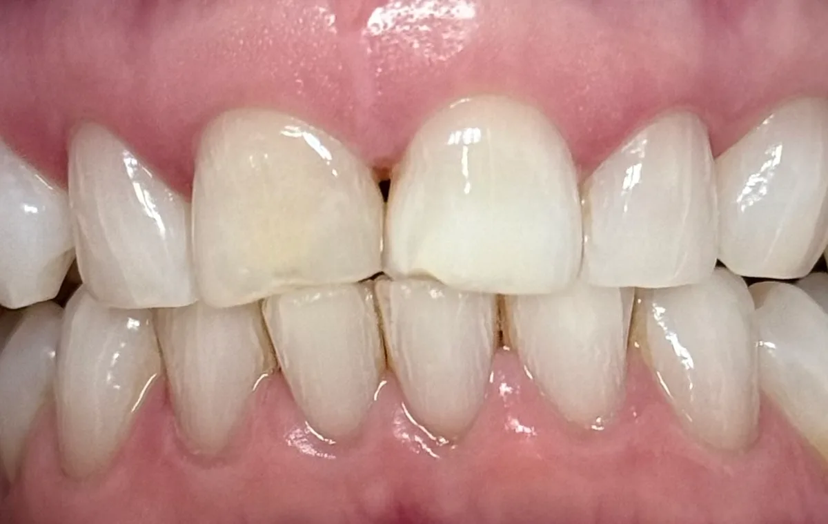 Before: Chairside Composite Veneers - Closed View