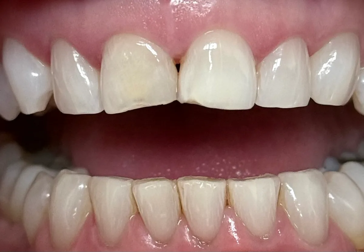 Before: Chairside Composite Veneers - Open View