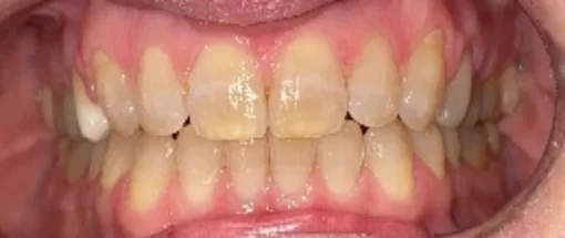 After: Upper Front Tooth And Lower Crowding