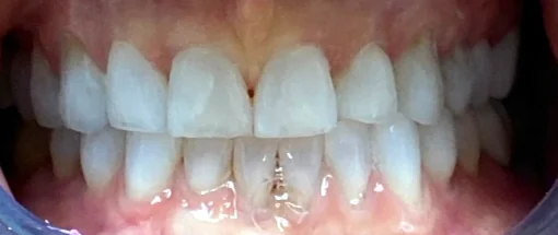 After: Edge To Edge Bite - Lower Crowding