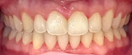 After: Edge To Edge Bite - Upper And Lower Crowding