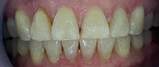 After: Crowding & Midline Refinement