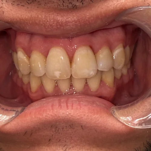 After: Crossbite Correction