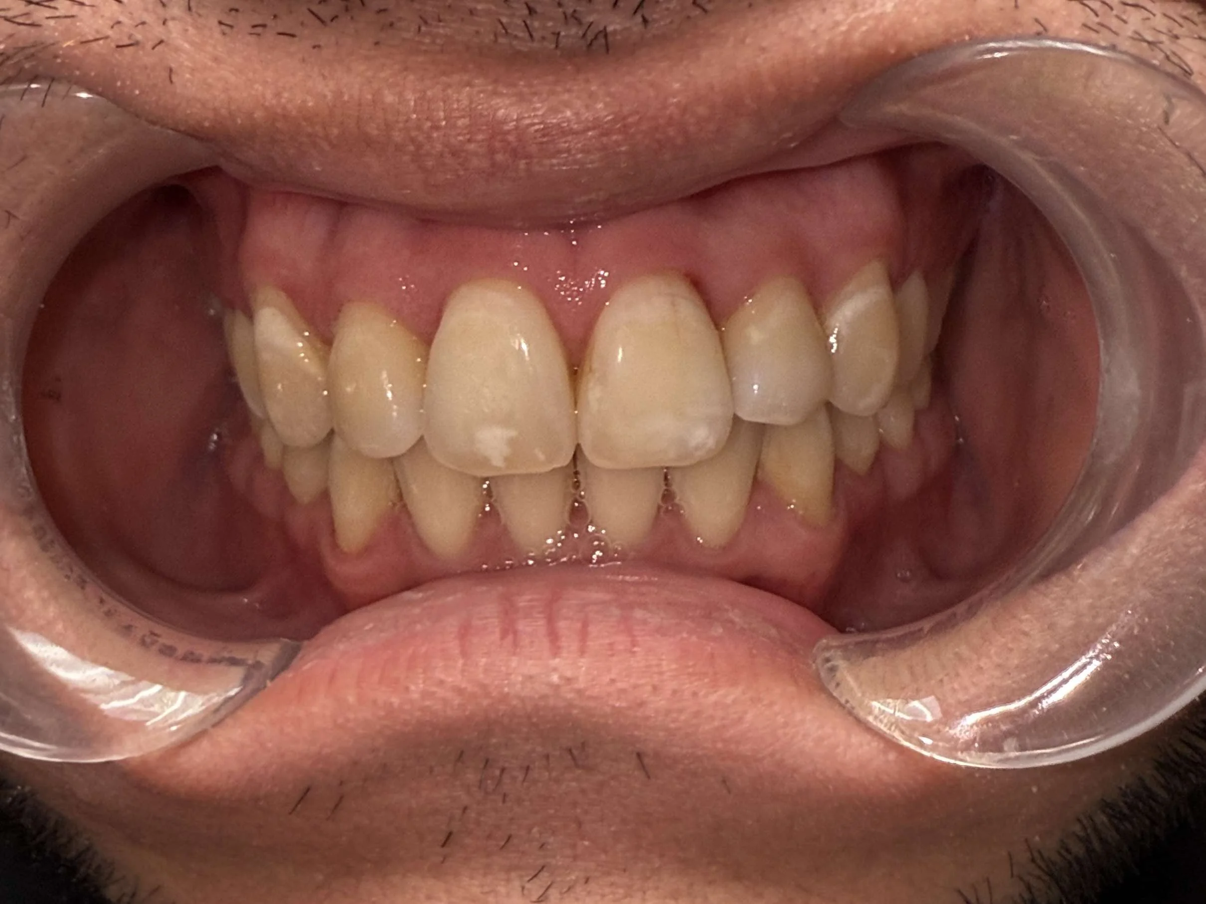 After: Comprehensive Smile Realignment
