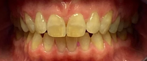 Before: Upper Front Tooth And Lower Crowding
