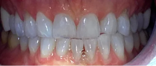 Before: Edge To Edge Bite - Lower Crowding