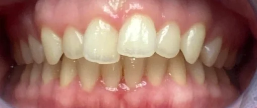 Before: Edge To Edge Bite - Upper And Lower Crowding