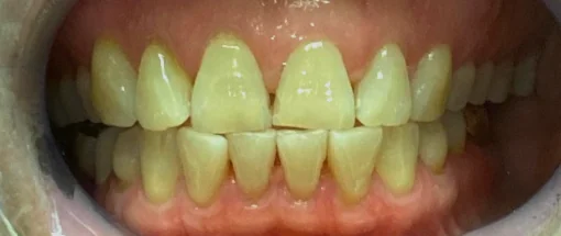 Before: Crowding & Midline Refinement