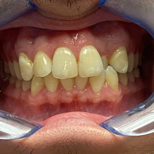 Before: Crossbite Correction