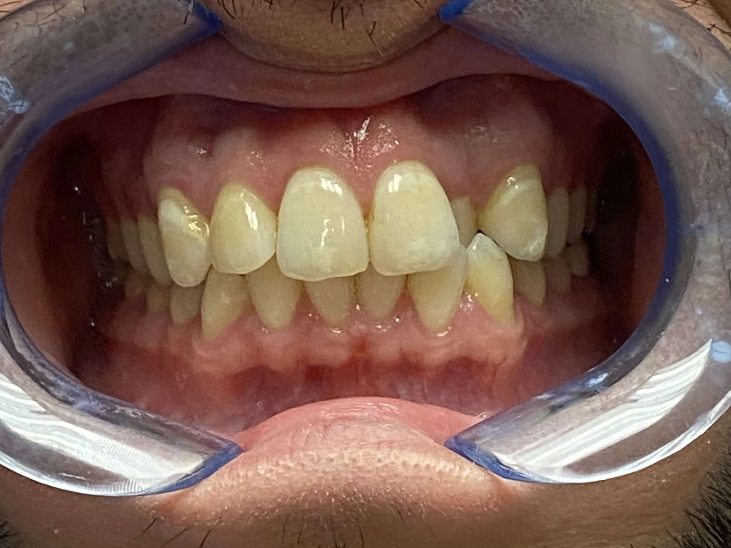 Before: Comprehensive Smile Realignment