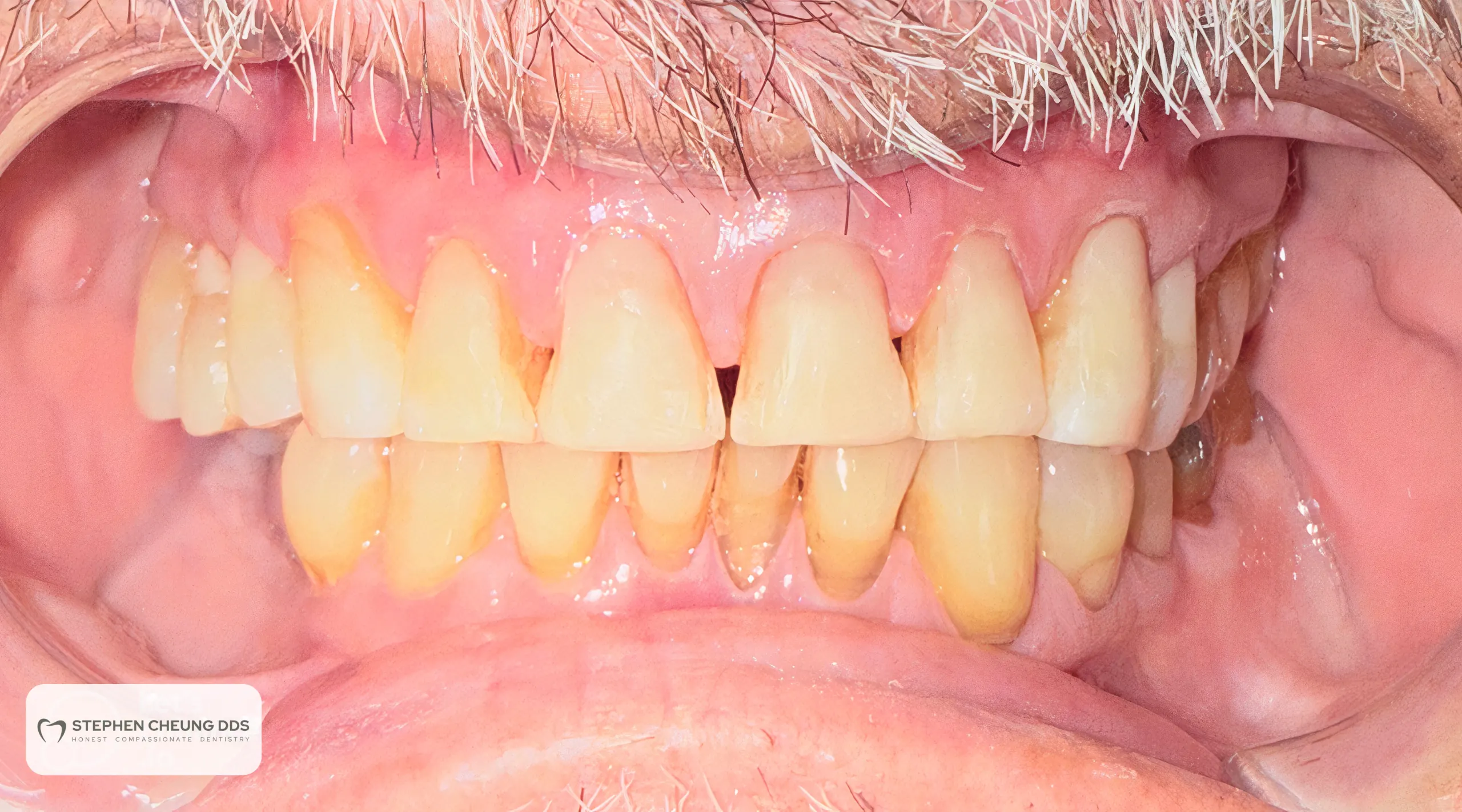 After: Six Upper Composite Veneers - No-Prep