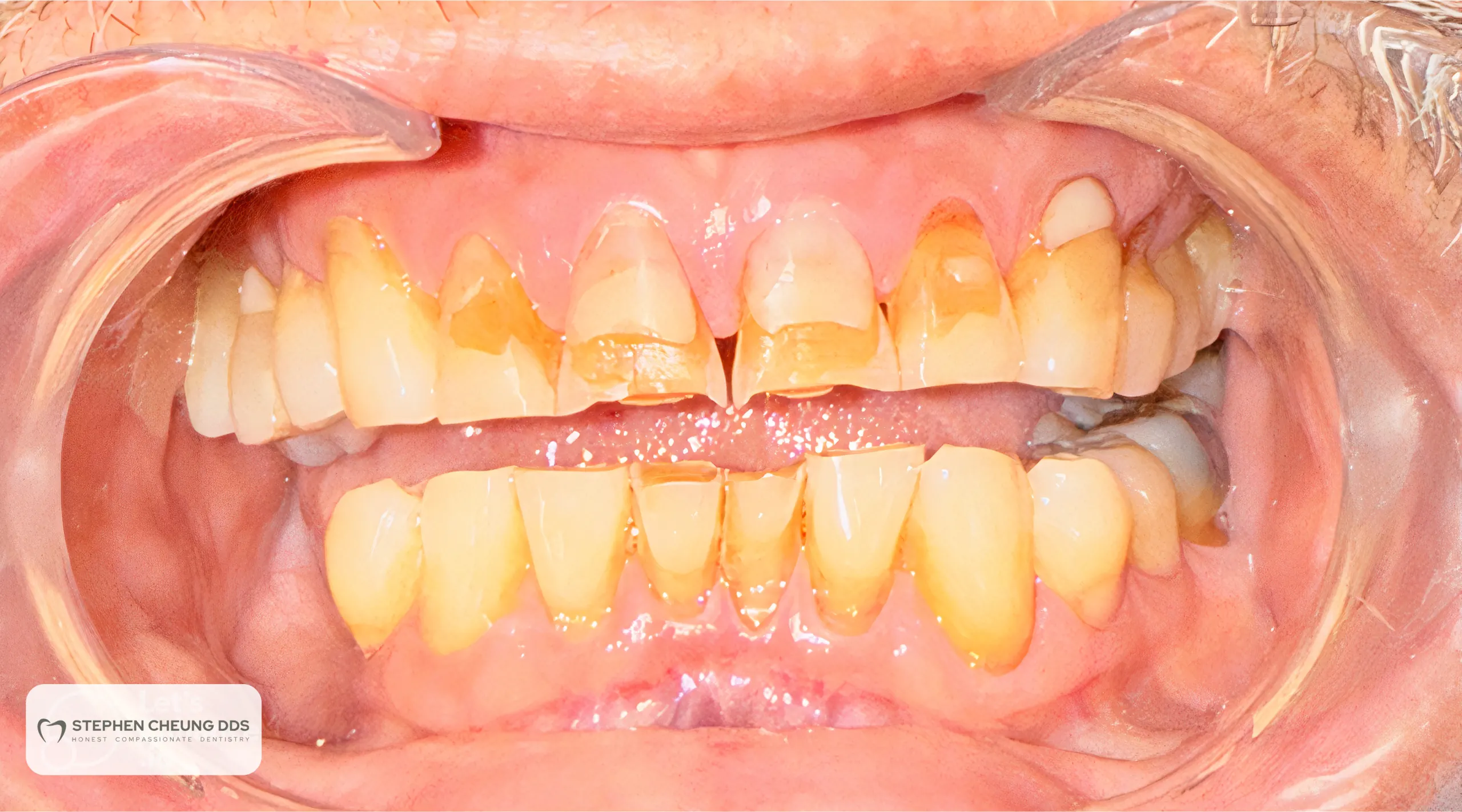 Before: Six Upper Composite Veneers - No-Prep
