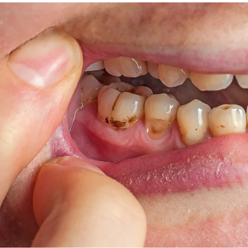 The Hidden Dangers of Plaque and Tartar: Prevention and Treatment