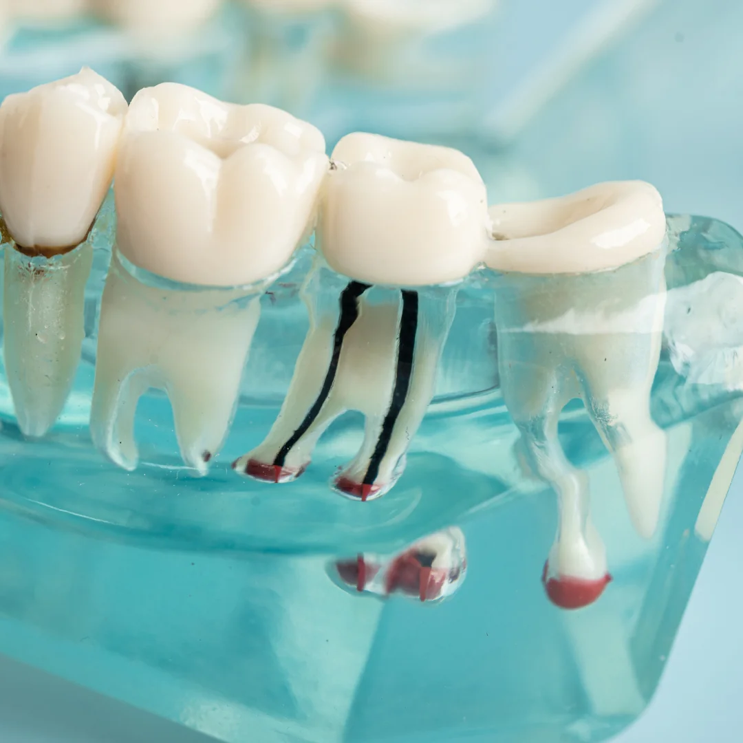 The Truth About Root Canals: What to Expect and How They Save Your Teeth