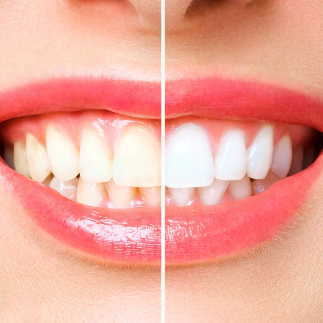 Top 5 Teeth Whitening Myths - Debunked by a Lodi Dentist