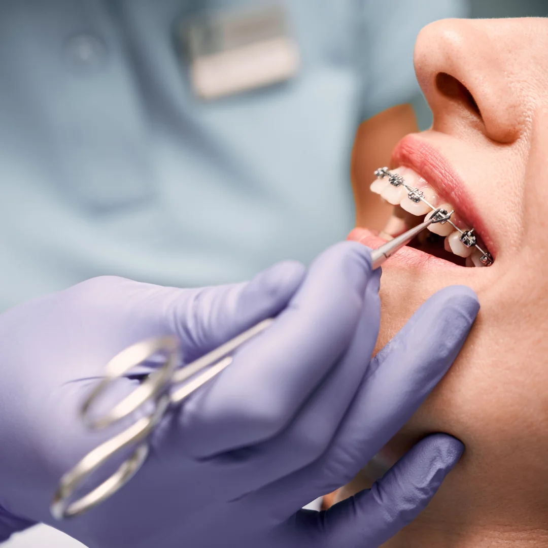 Braces (Clear & Traditional)