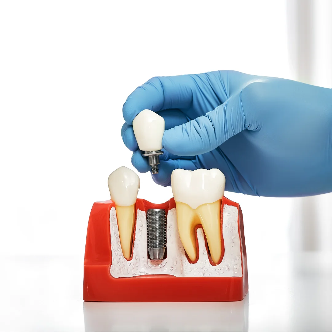 Dental Implants