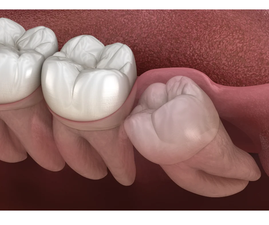 Tooth Extractions