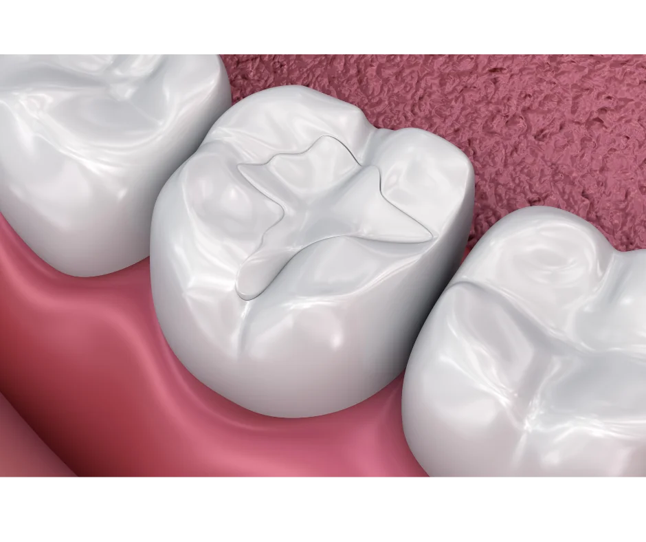Tooth-Colored Fillings