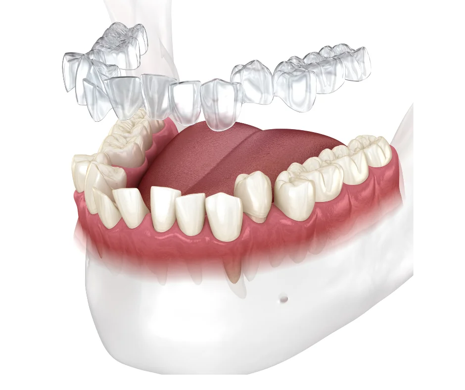 Invisalign® Clear Aligners