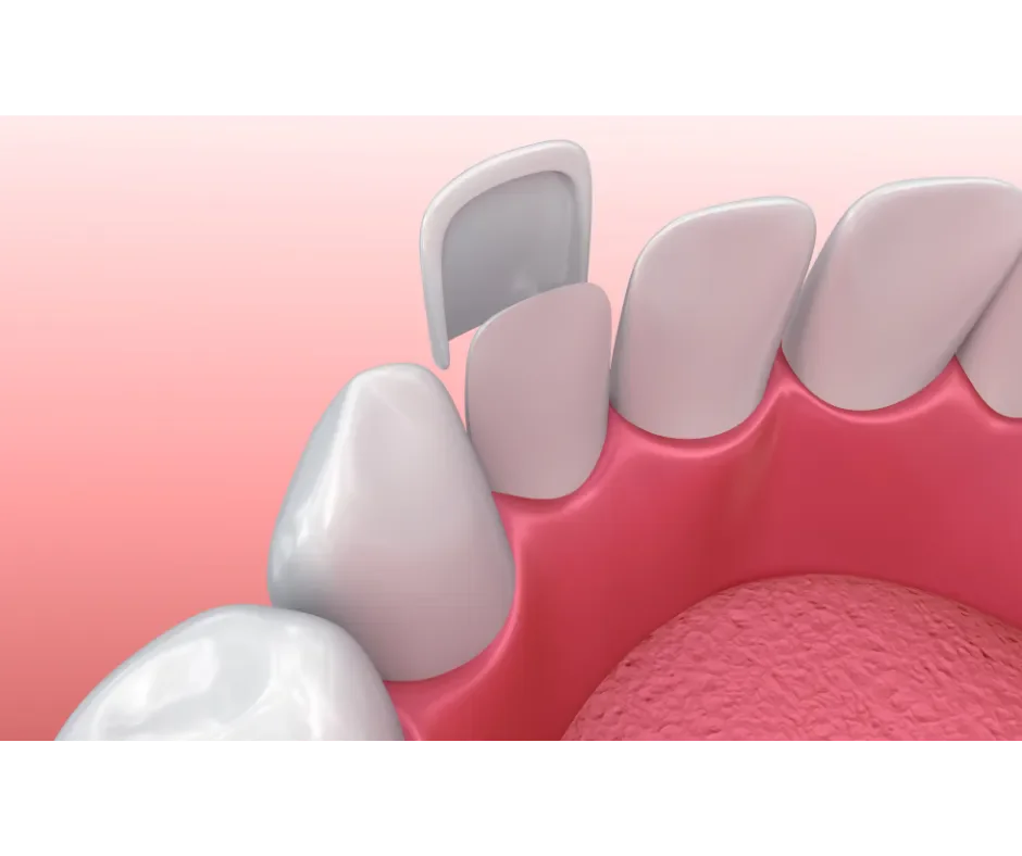 Veneers