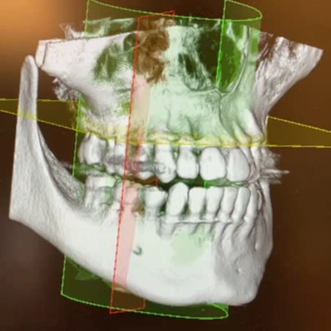 CBCT 3D imaging machine